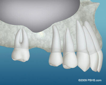 Sinus lift Surgery