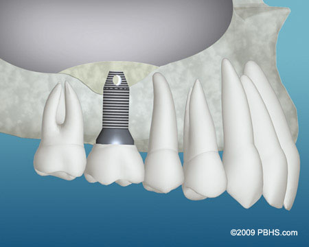 Bone Grafting